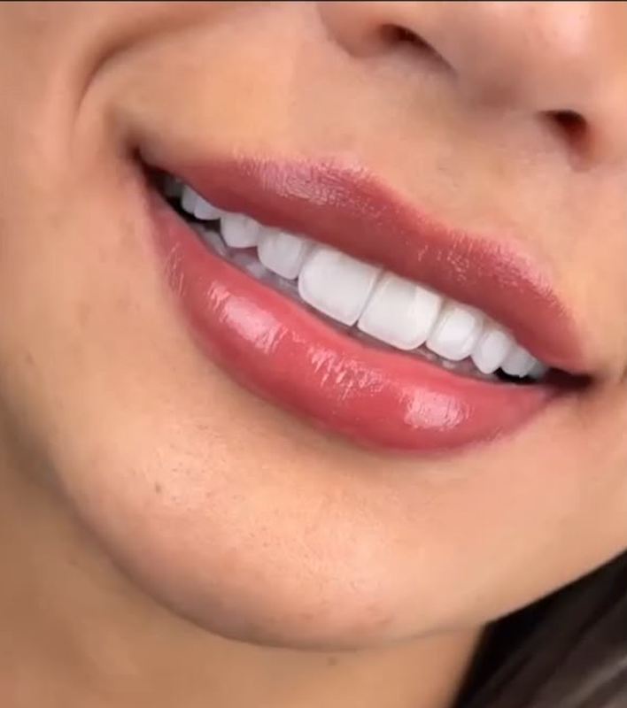 Hollywood Smile Offer 1