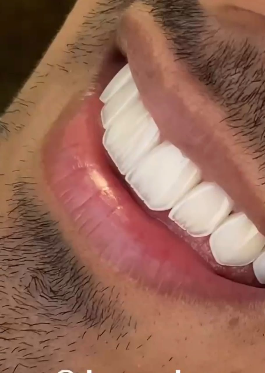 Hollywood Smile Offer 2