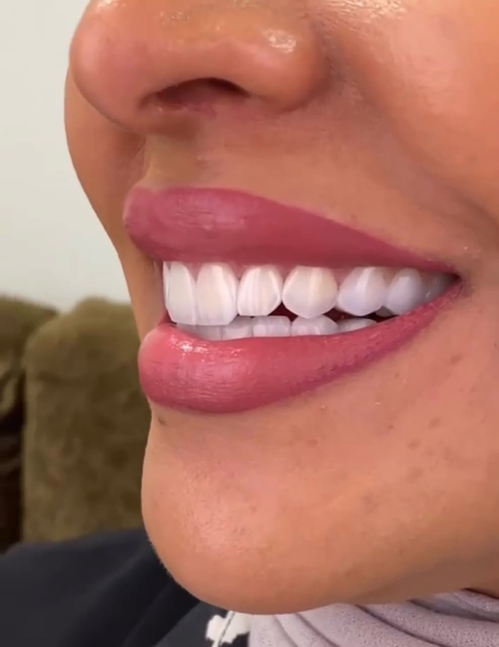 Hollywood Smile Offer 3